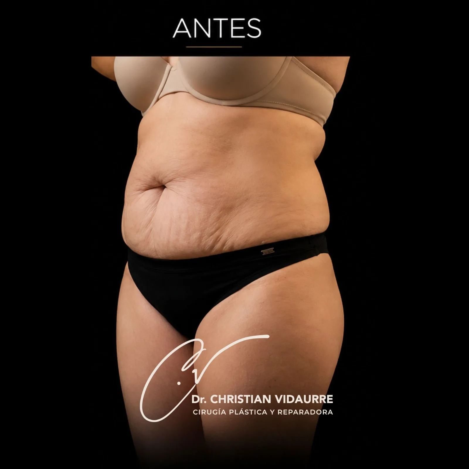 Abdominoplastia — antes