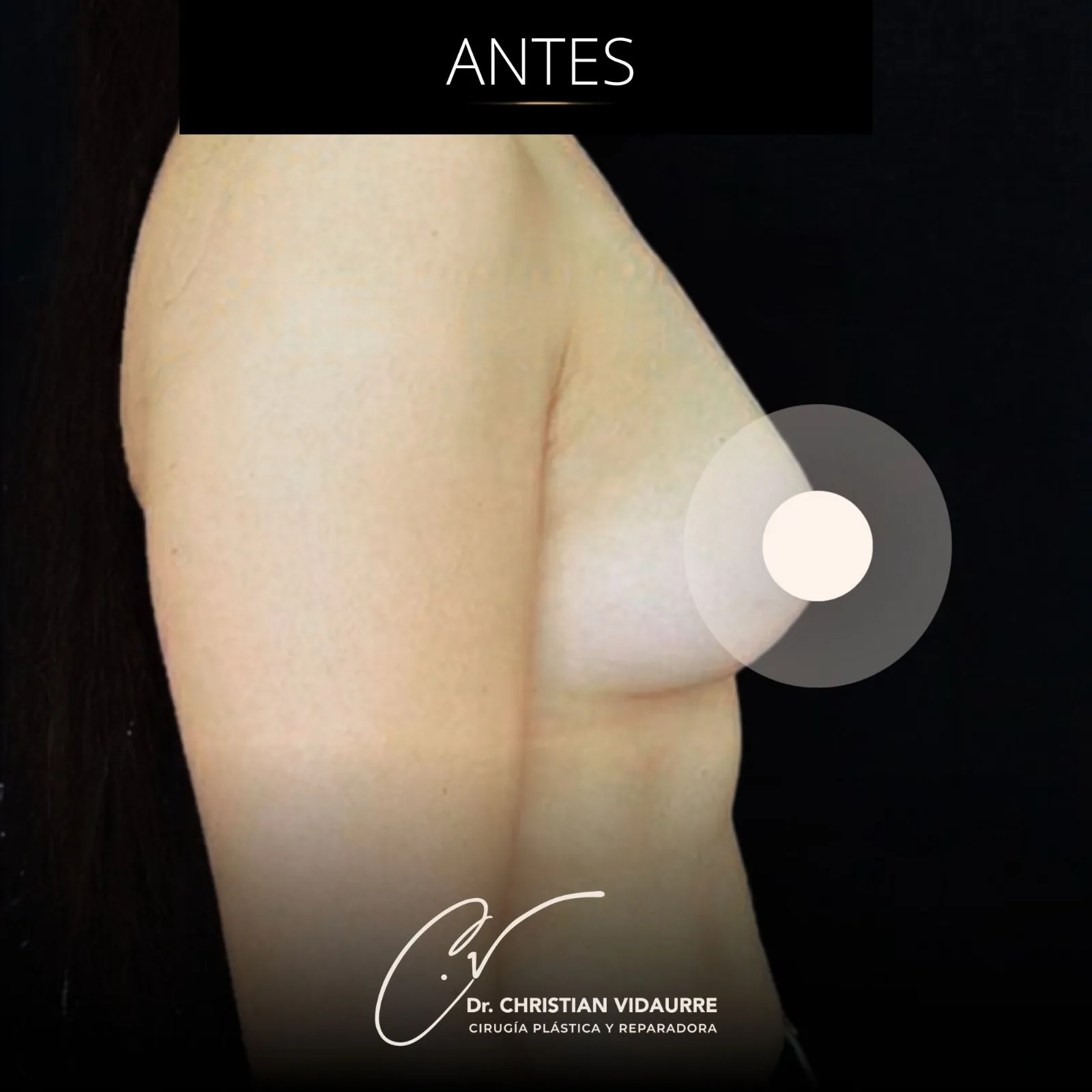 Aumento Mamario — antes