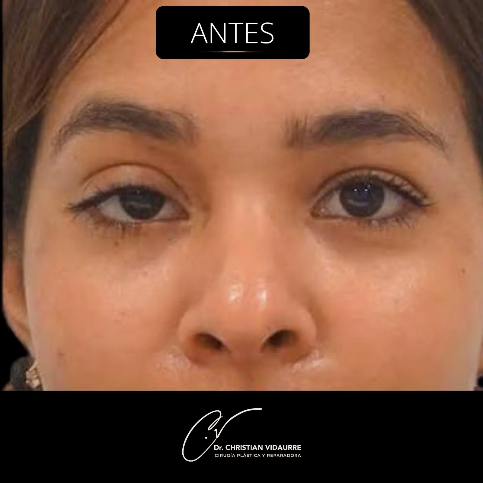 Blefaroplastia — antes