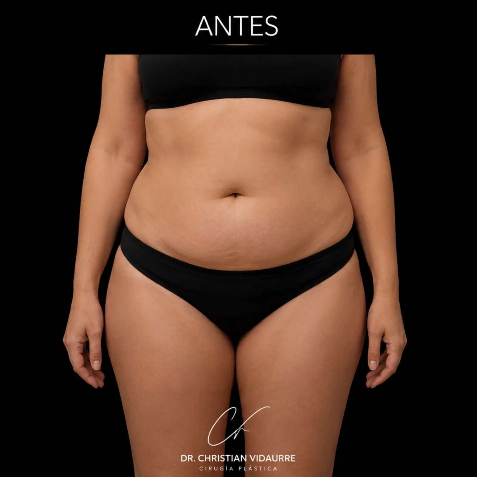 Lipoescultura — antes