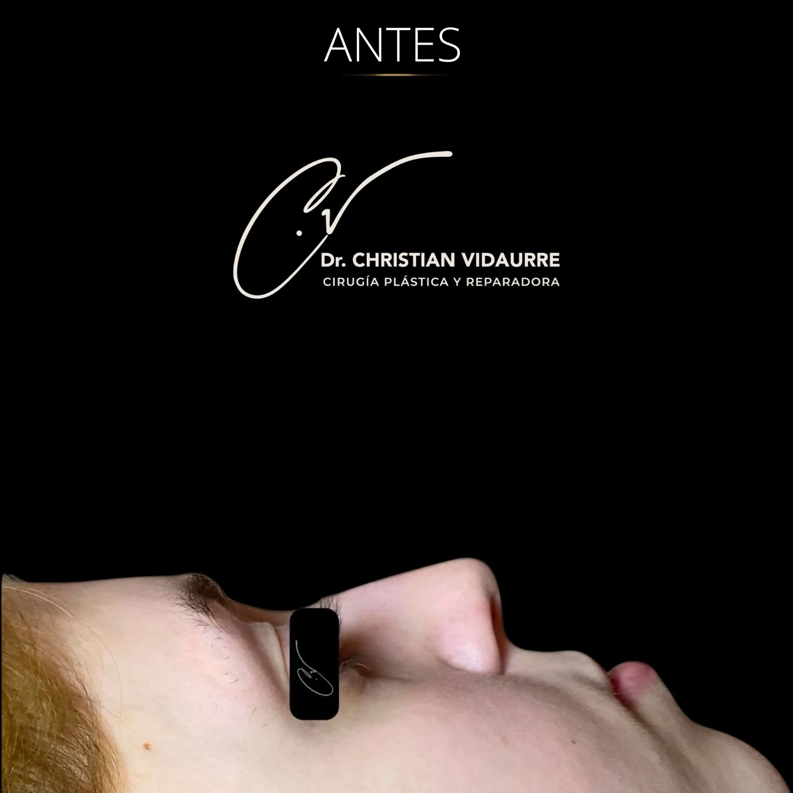 Rinoplastia — antes