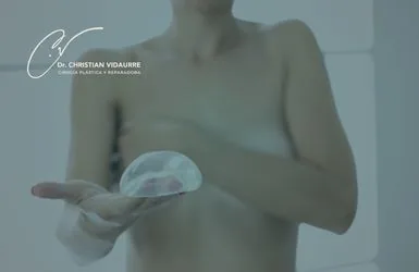 Tipos de implantes mamarios: cómo elegir el adecuado