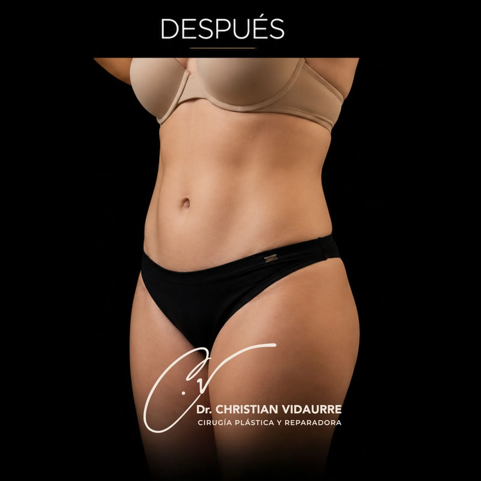 Abdominoplastia — después