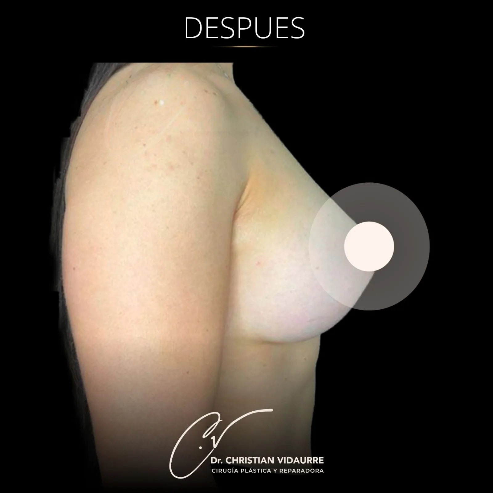 Aumento Mamario — después