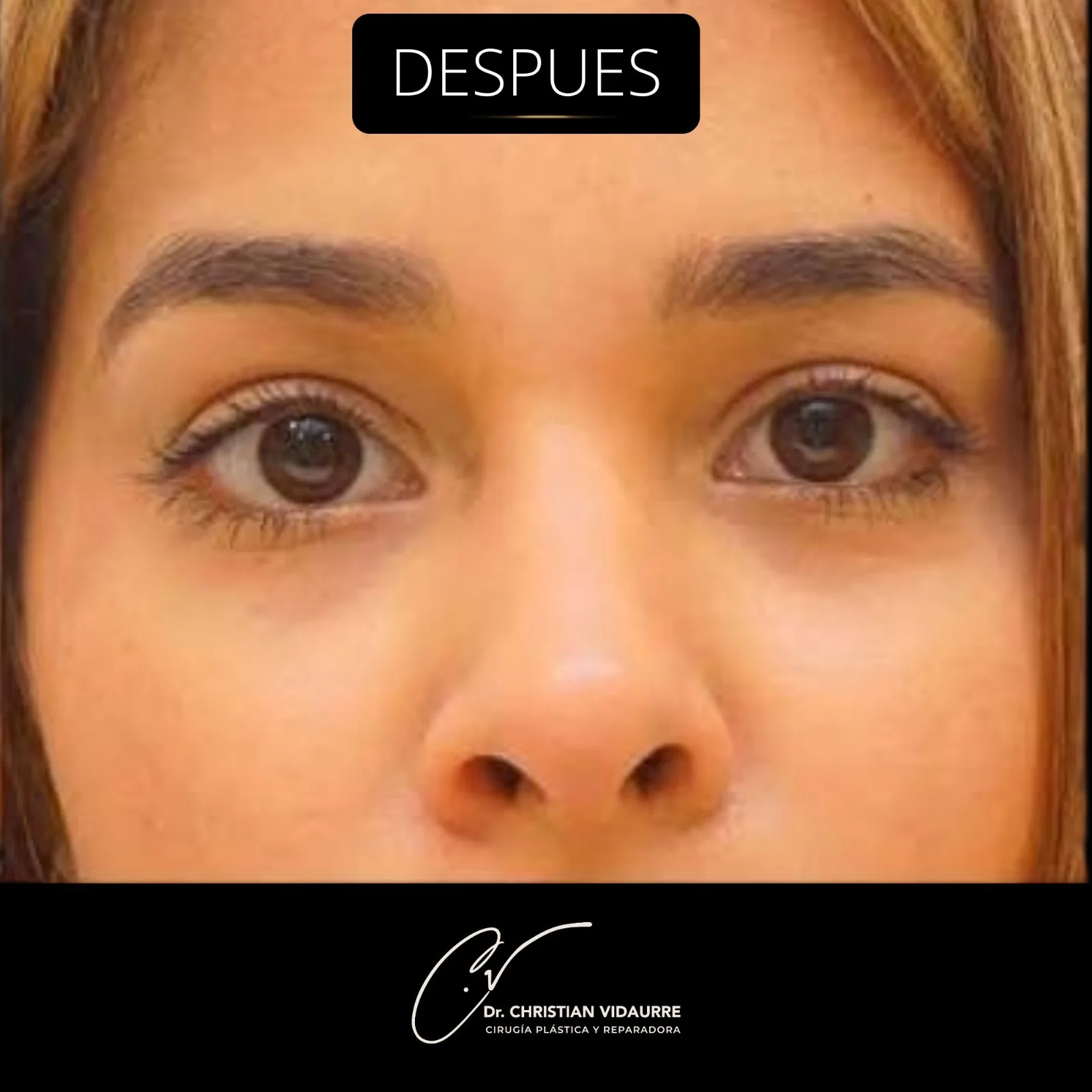 Blefaroplastia — después