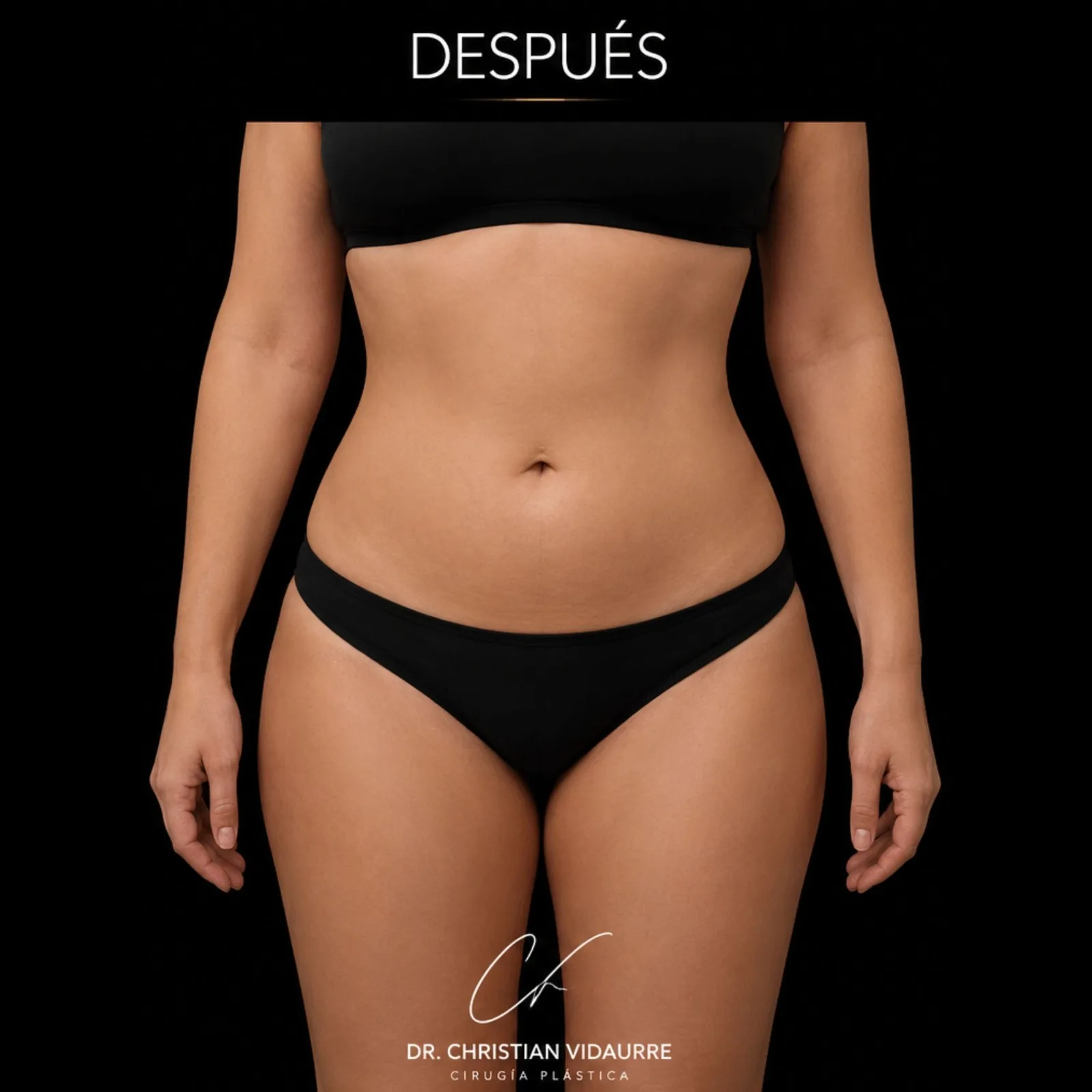 Lipoescultura — después