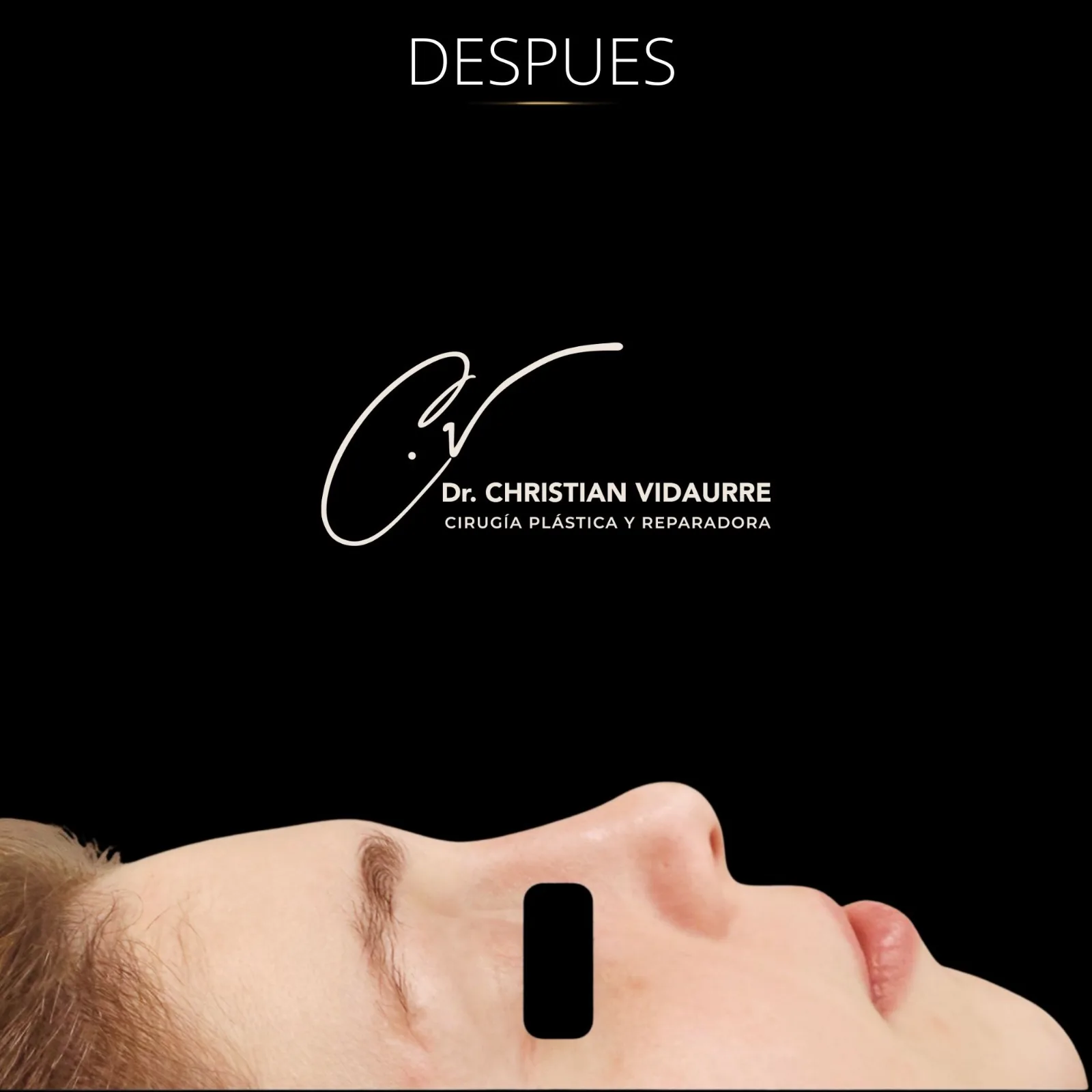 Rinoplastia — después
